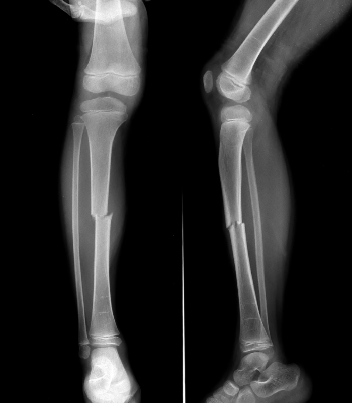 Image of leg bone fracture x-ray taken at Seven Oaks X-Ray Clinic in Winnipeg, MB