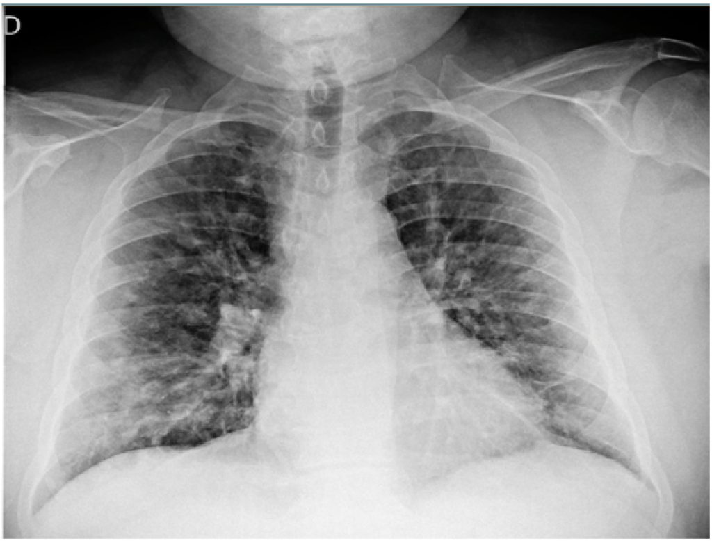 Xray taken at a Winnipeg clinic showing pneumonia, a lung infection